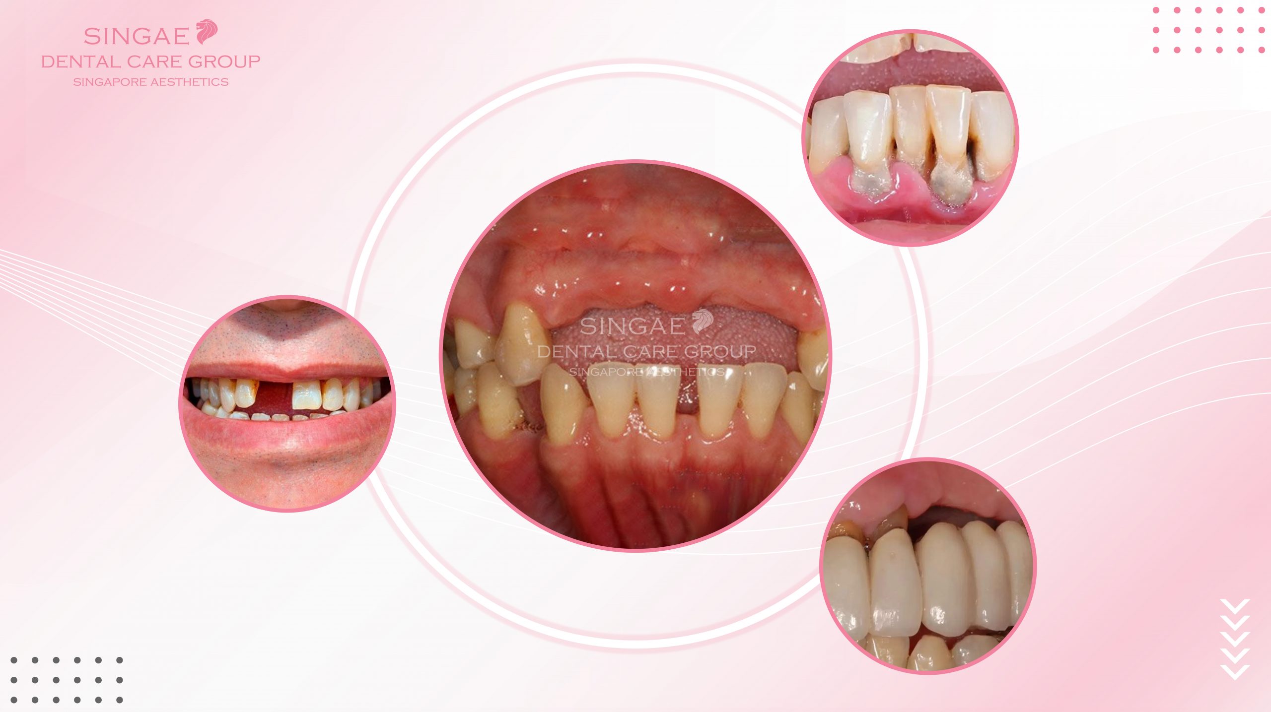 [3+] Nguyên nhân tiêu xương hàm là gì? – Singae Dental