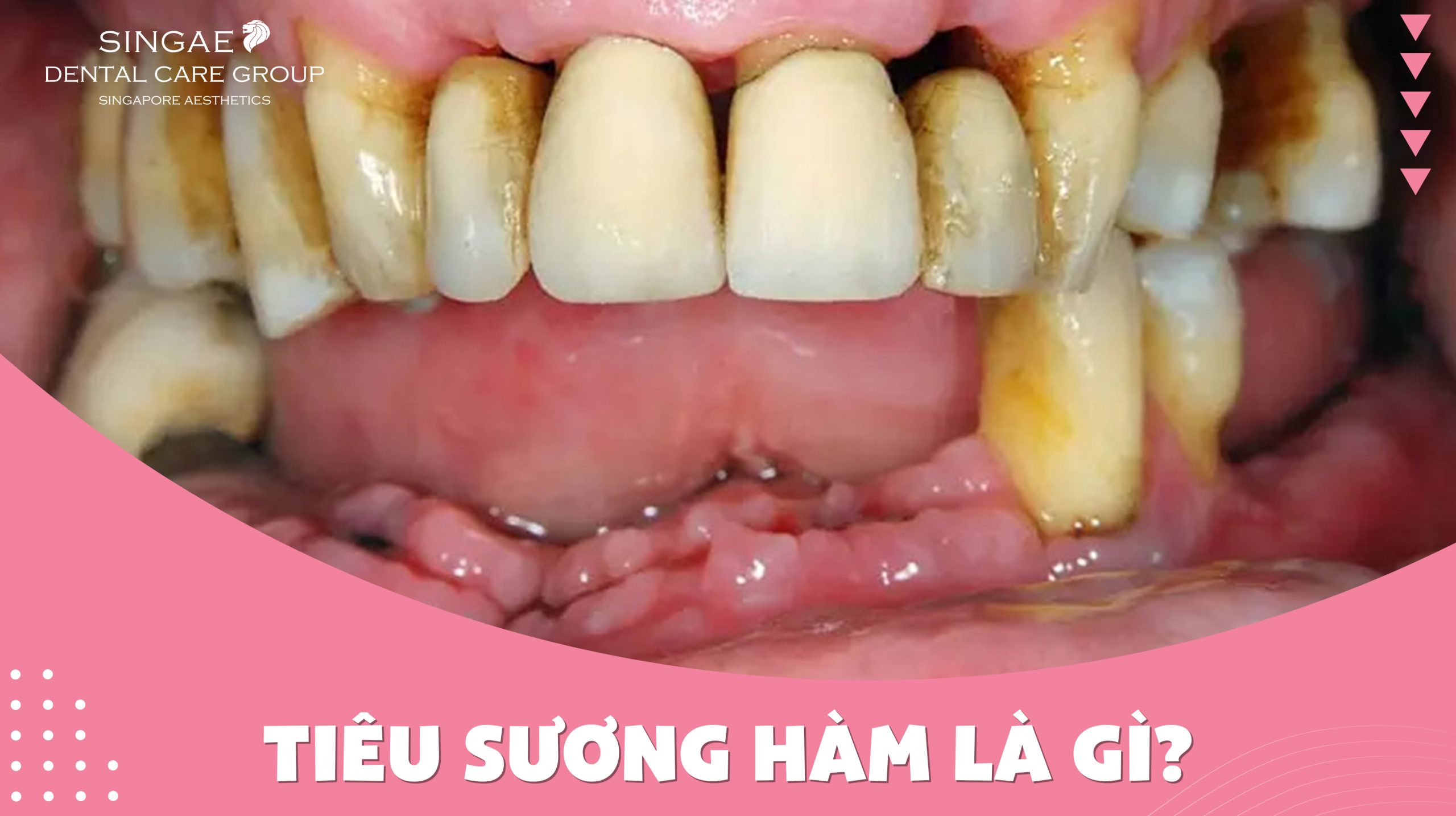 Tiêu xương hàm là gì? Tiêu xương có biểu hiện gì?