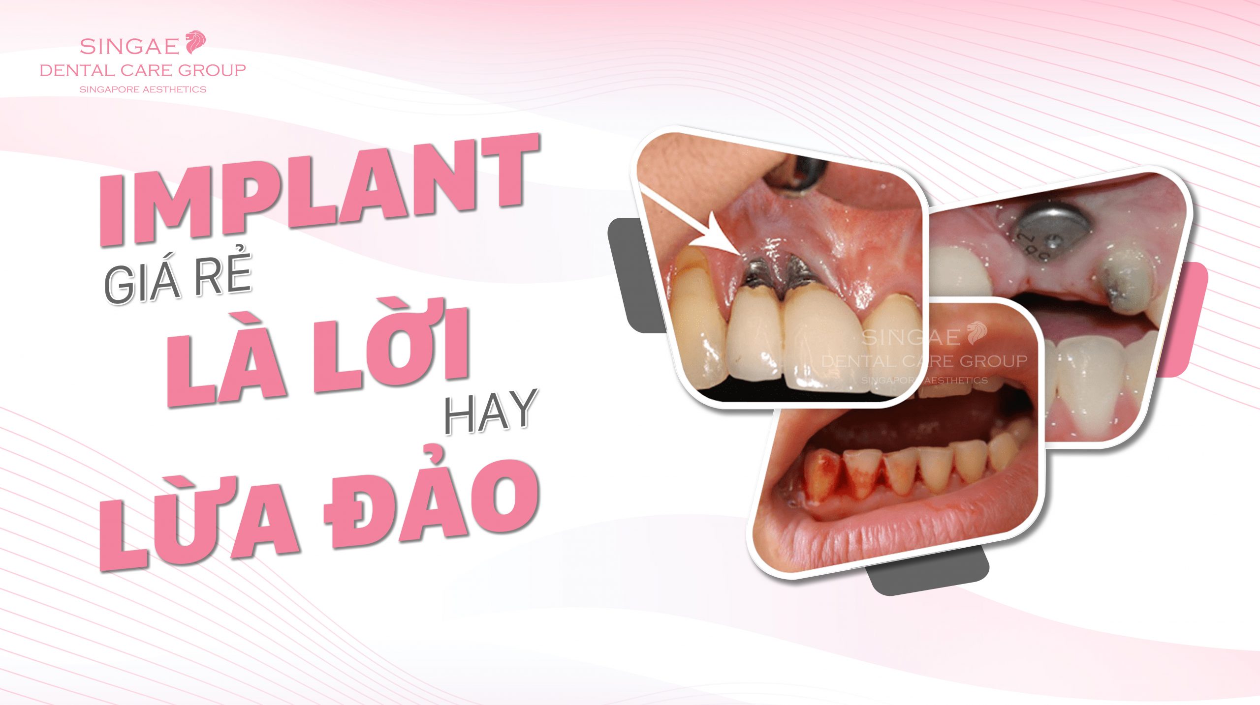 Vạch trần bộ mặt của Implant giá rẻ