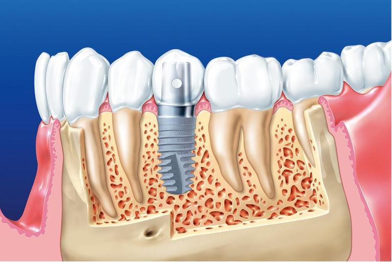 Còn chân răng thì có bị tiêu xương không? 6 Còn chân răng thì có bị tiêu xương không?
