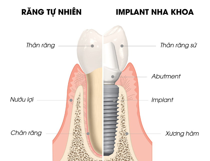 [ Bật mí ] Top 10 lý do mà bạn nên cấy răng Implant