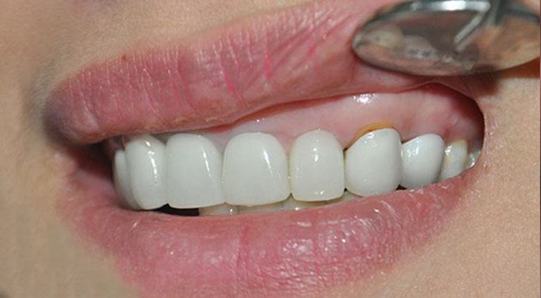 Bọc răng sứ bị cộm do đâu? Dấu hiệu nhận biết và cách khắc phục