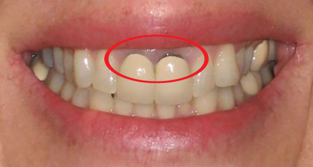 [ Khi nào cần thay răng sứ ]: Nguyên nhân, trường hợp, lưu ý