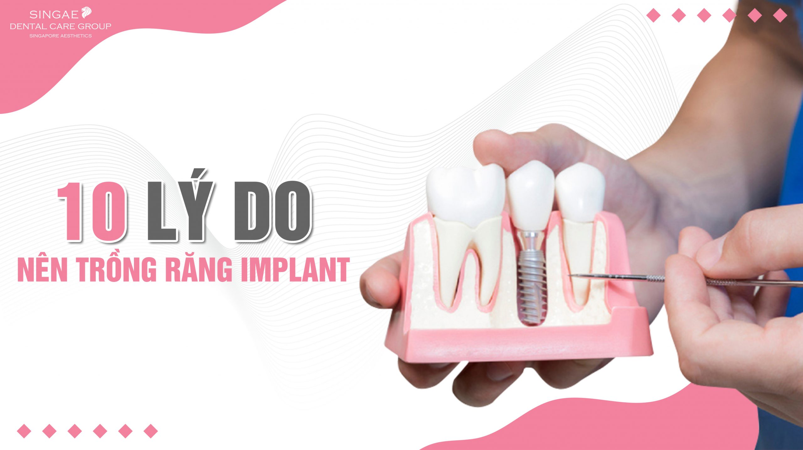 [ Bật mí ] Top 10 lý do mà bạn nên cấy răng Implant