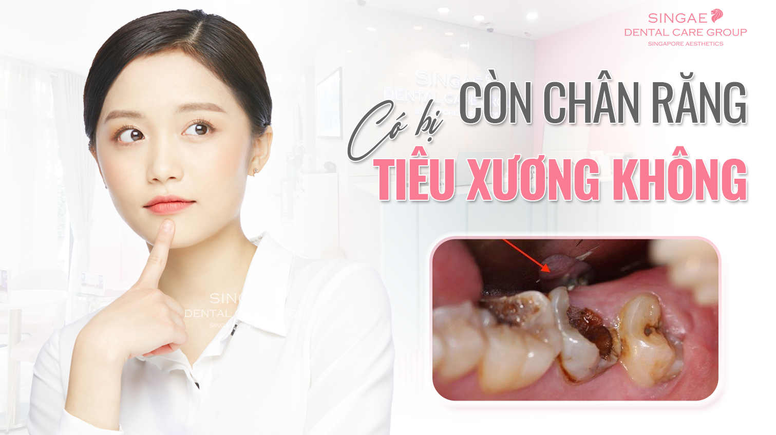 Còn chân răng thì có bị tiêu xương không?