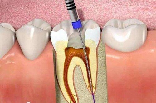 Trám răng lấy tủy và những thông tin nhất định bạn nên biết