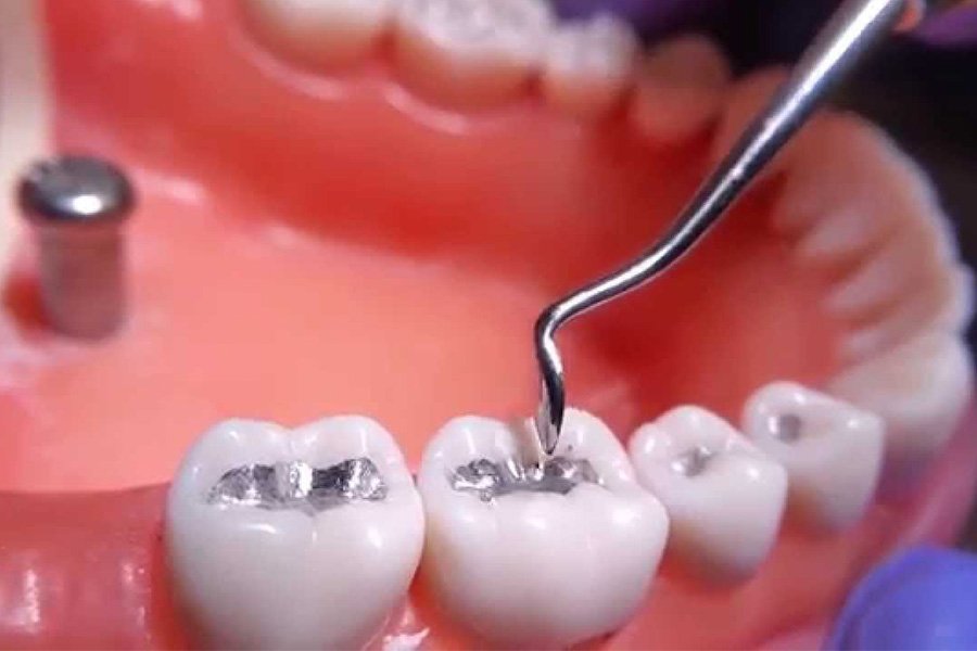 [ Top 7+ ] tác hại của việc trám răng tại nhà và sai cách
