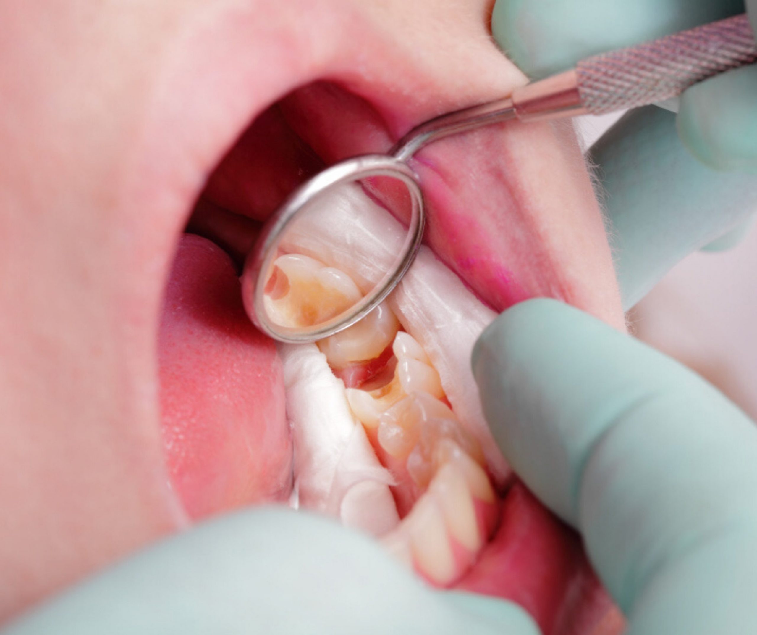 Điều trị tuỷ răng cho bé 
