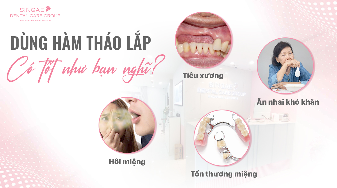 Các loại hàm giả tháo lắp? Ưu nhược điểm của hàm giả tháo lắp?