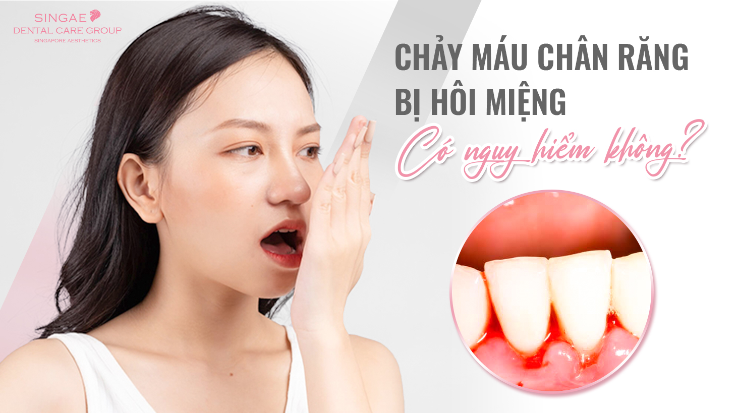 Chảy máu chân răng hôi miệng là biểu hiện cuả bệnh gì? Cách điều trị?
