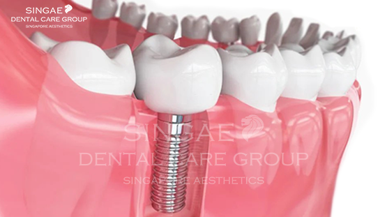 Mất răng lâu năm có trồng được không? Nên trồng Implant ở đâu?