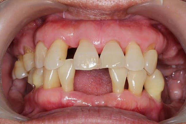 Nguyên nhân tụt lợi chân răng 