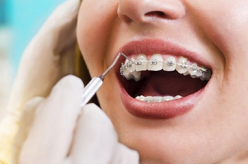 Những điều cần phải lưu ý khi niềng răng là gì?
