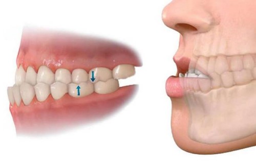 Răng móm: Nguyên nhân, tác hại, cách điều trị 5 Răng móm: Nguyên nhân, tác hại, cách điều trị