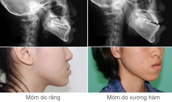Răng móm: Nguyên nhân, tác hại, cách điều trị 7 Răng móm: Nguyên nhân, tác hại, cách điều trị