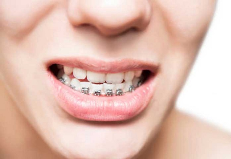 Răng móm: Nguyên nhân, tác hại, cách điều trị 8 Răng móm: Nguyên nhân, tác hại, cách điều trị