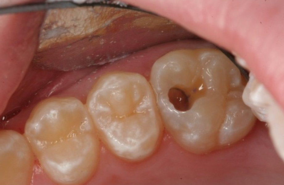Chân răng bị mục: Nguyên nhân, Dấu hiệu, Hậu quả, Cách khắc phục