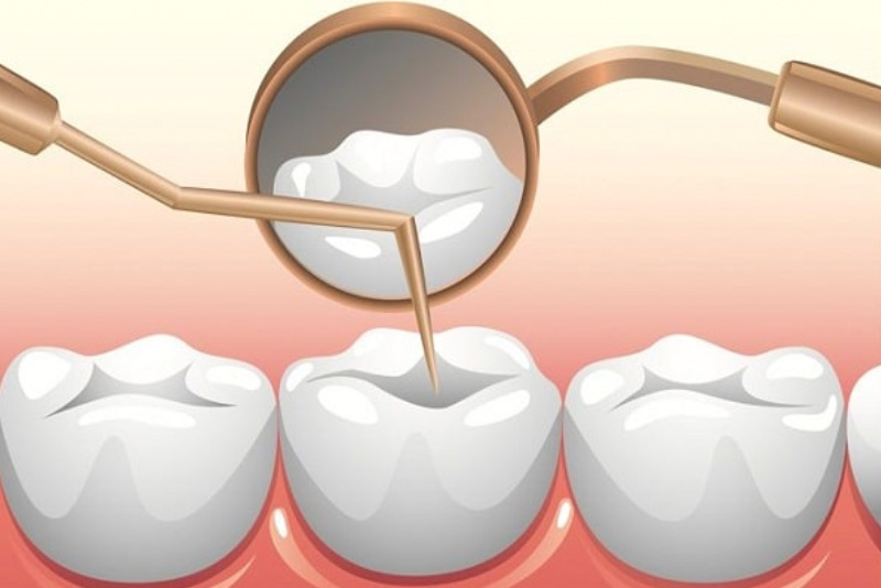 Chân răng bị mục: Nguyên nhân, Dấu hiệu, Hậu quả, Cách khắc phục