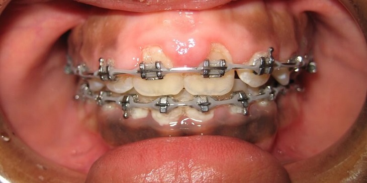 Niềng răng bị tụt lợi: Nguyên nhân, Cách khắc phục như thế nào