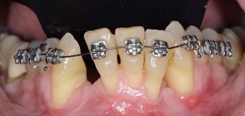 Niềng răng bị tụt lợi: Nguyên nhân, Cách khắc phục như thế nào