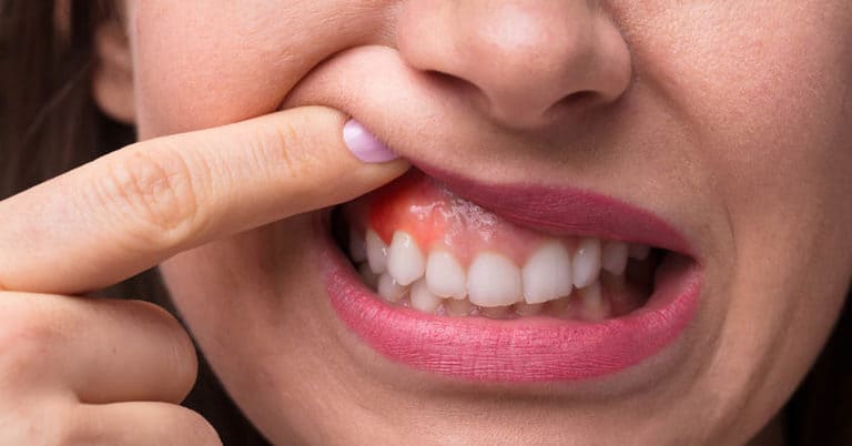 Răng giả bị đau: Nguyên nhân, Cách điều trị