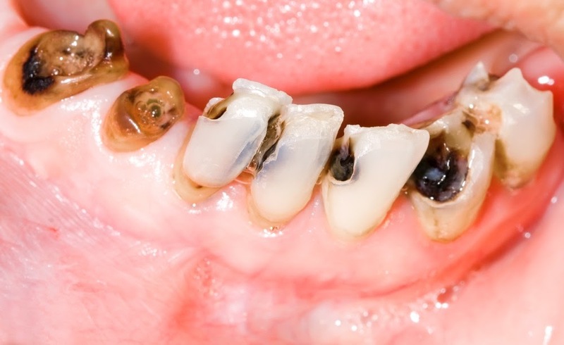 Răng nhạy cảm: Dấu hiệu, Nguyên nhân, Cách khắc phục 12 Răng nhạy cảm: Dấu hiệu, Nguyên nhân, Cách khắc phục