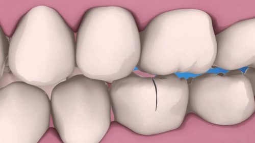 Răng nhạy cảm: Dấu hiệu, Nguyên nhân, Cách khắc phục 13 Răng nhạy cảm: Dấu hiệu, Nguyên nhân, Cách khắc phục