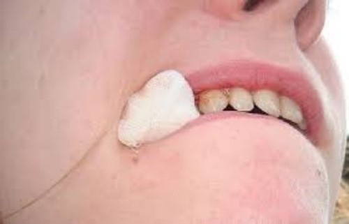 Hướng dẫn cách chăm sóc sau khi trồng răng Implant