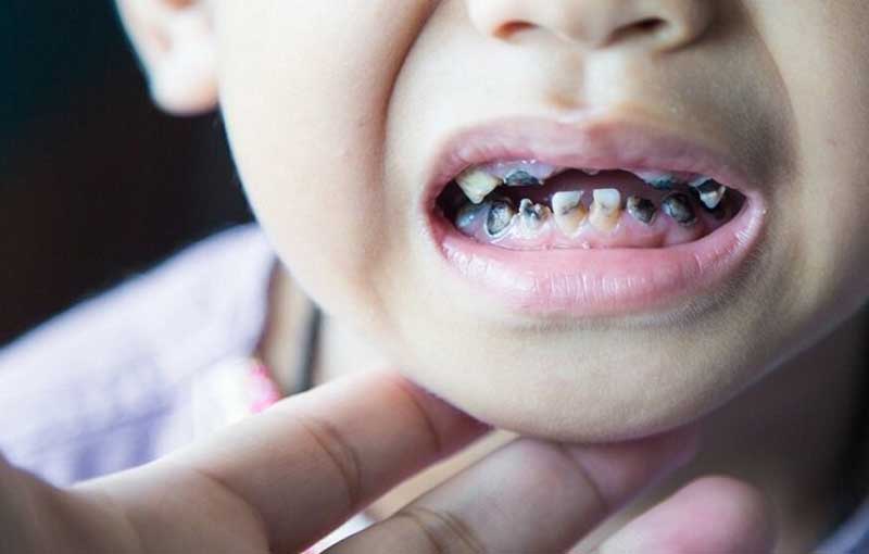 Sún răng ở trẻ em: Nguyên nhân, Dấu hiệu, Cách điều trị