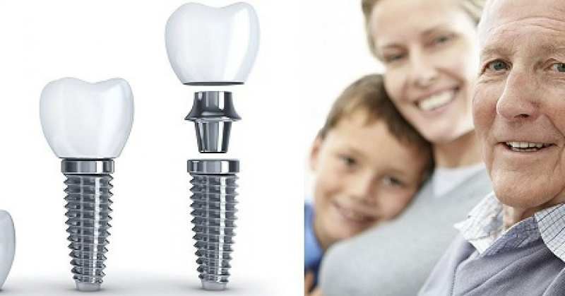 Phẫu thuật cấy ghép Implant 7 phút không đau