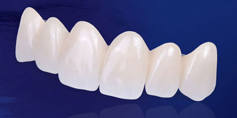 Nên trồng răng sứ hay Implant? Các tiêu chí lựa chọn nha khoa uy tín