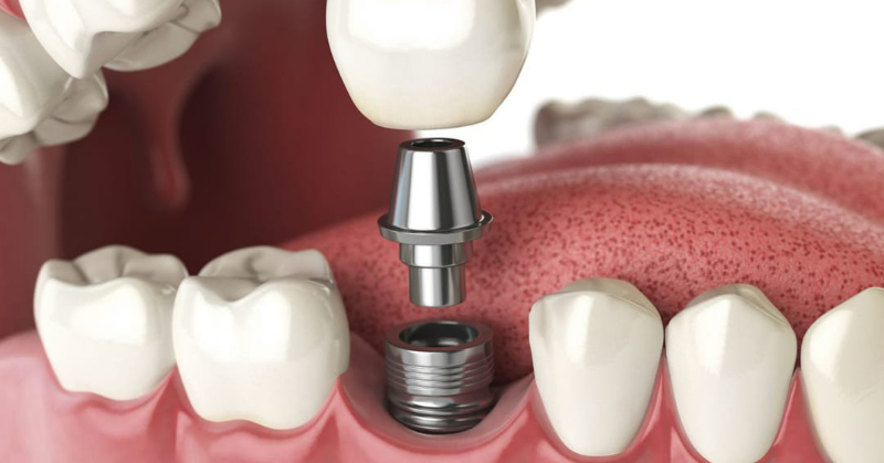 Trồng răng Implant có được bảo hiểm không?