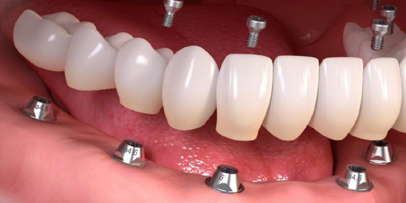 Trông răng Implant nguyên hàm là gì? Trồng răng Implant nguyên hàm giá bao nhiêu?