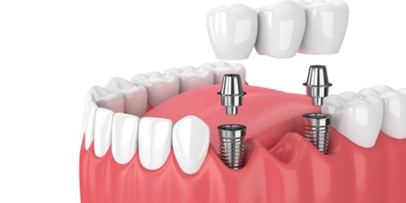 Trồng răng implant giá rẻ nhất là mấy 1 trụ? Chớ ham rẻ!