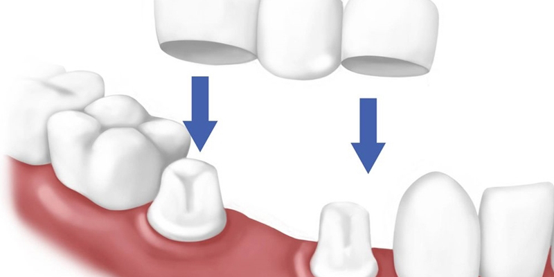 Làm cầu răng sứ