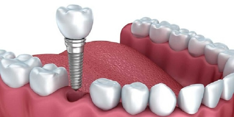 Trồng răng Implant vĩnh viễn có tốt không? Loại trụ Implant nào tốt nhất? Chi phí trồng răng Implant là bao nhiêu?