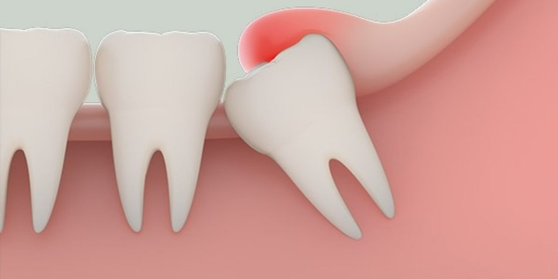 Nhổ răng số 8 có những biến chứng gì? Những lưu ý khi nhổ răng số 8