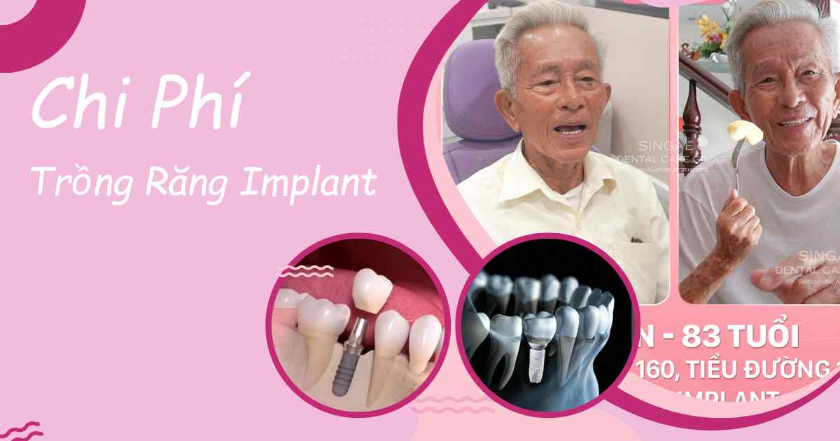 Tổng chi phí trồng răng Implant là bao nhiêu?
