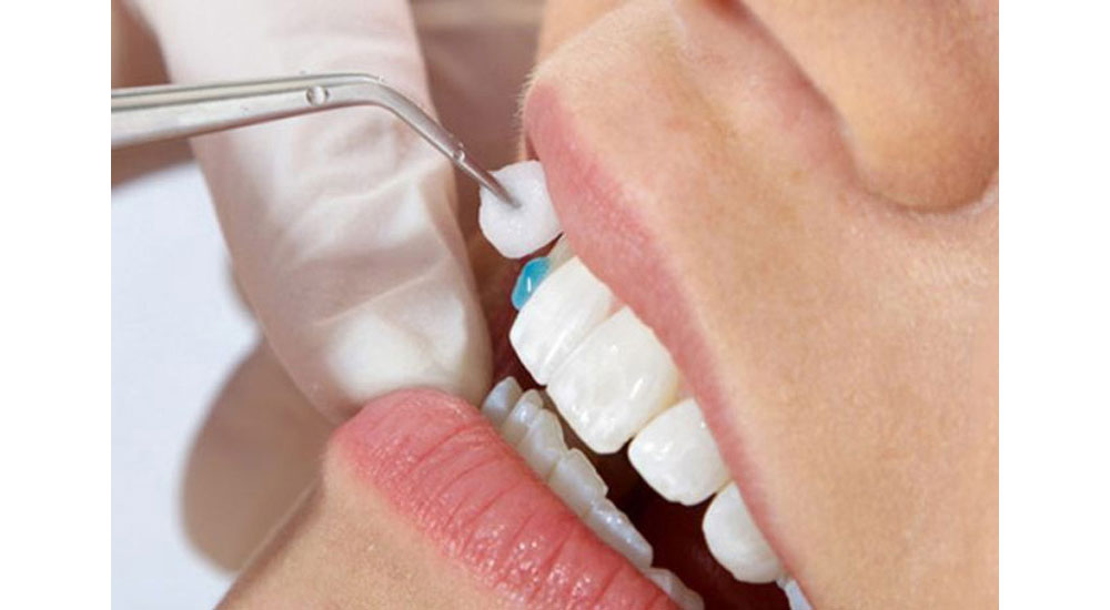 Làm răng sứ có bị ê buốt không, mức độ thế nào còn tùy vào tay nghề bác sĩ