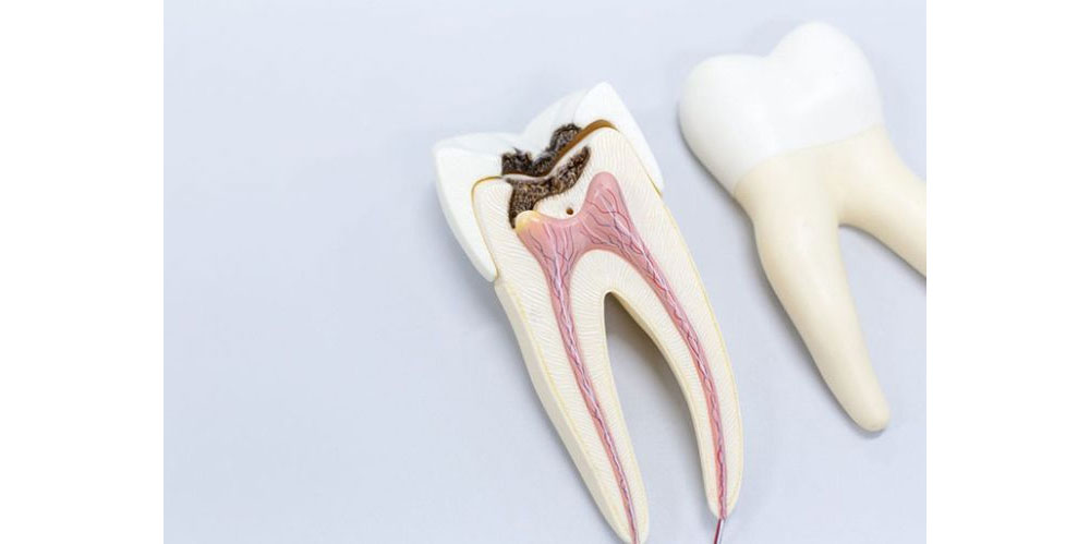 Lấy tủy bọc răng sứ mất bao lâu là hoàn thiện?