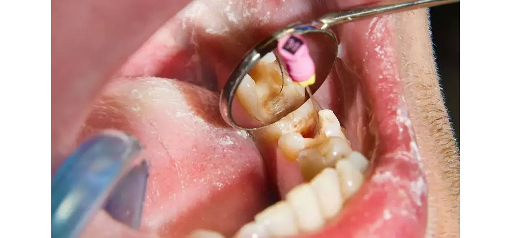 Giá bọc răng sứ sau khi lấy tủy tại nha khoa Singae là bao nhiêu?
