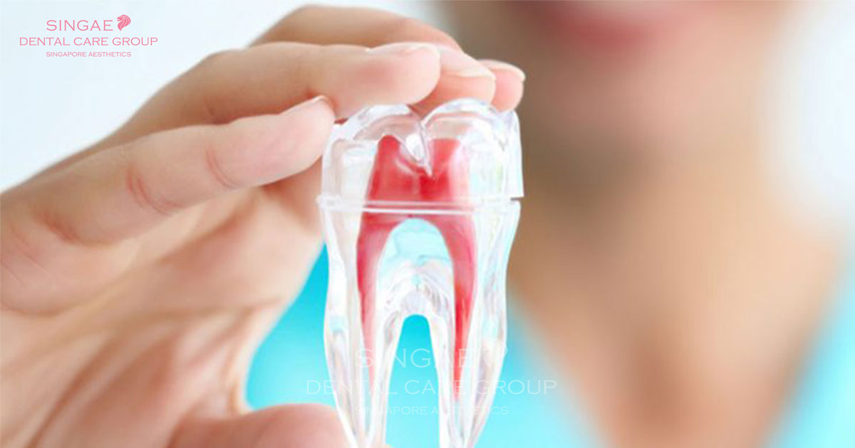 Lấy tủy bọc răng sứ giá bao nhiêu, tuổi thọ được bao lâu?