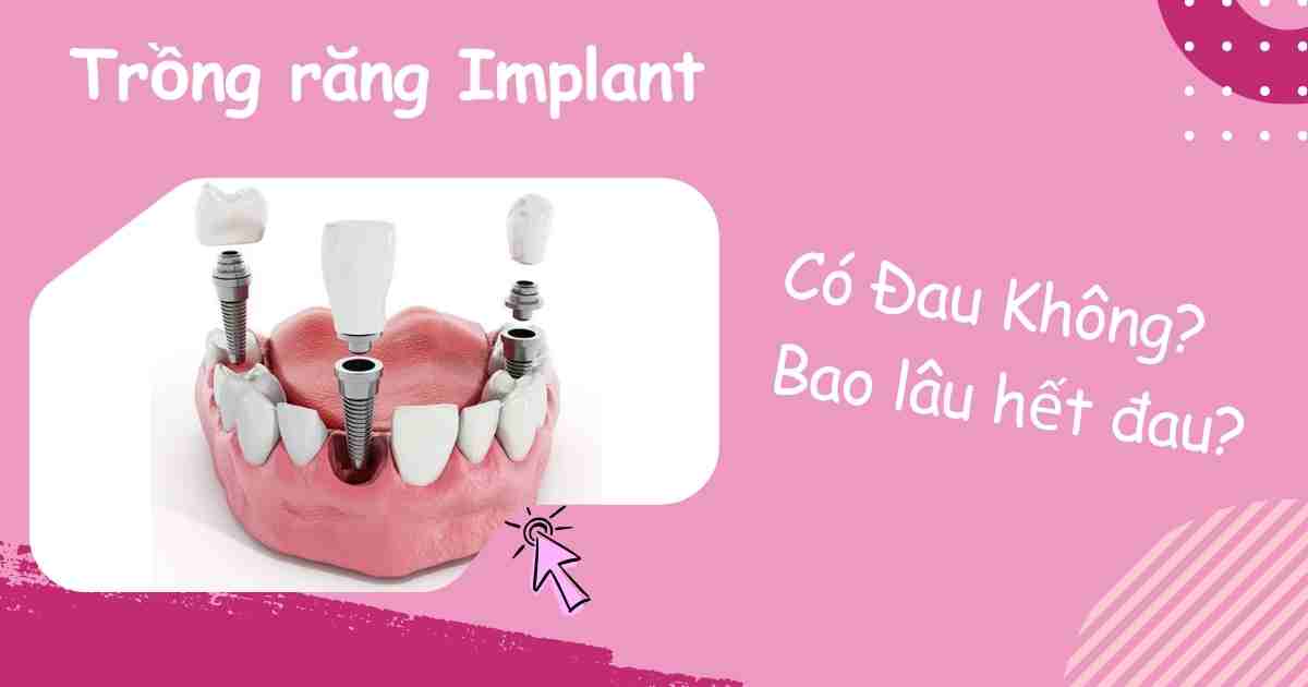 Trồng răng Implant có đau không, Bao lâu thì hết đau?