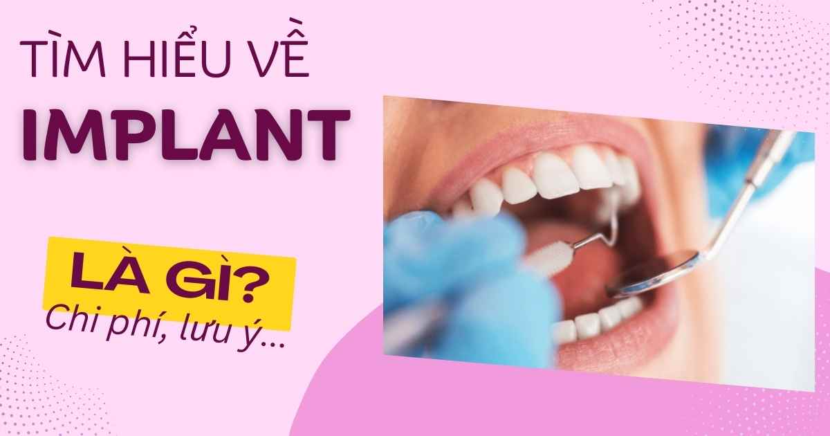 Trồng răng Implant là gì, có mấy cách? Ưu điểm, rủi ro?