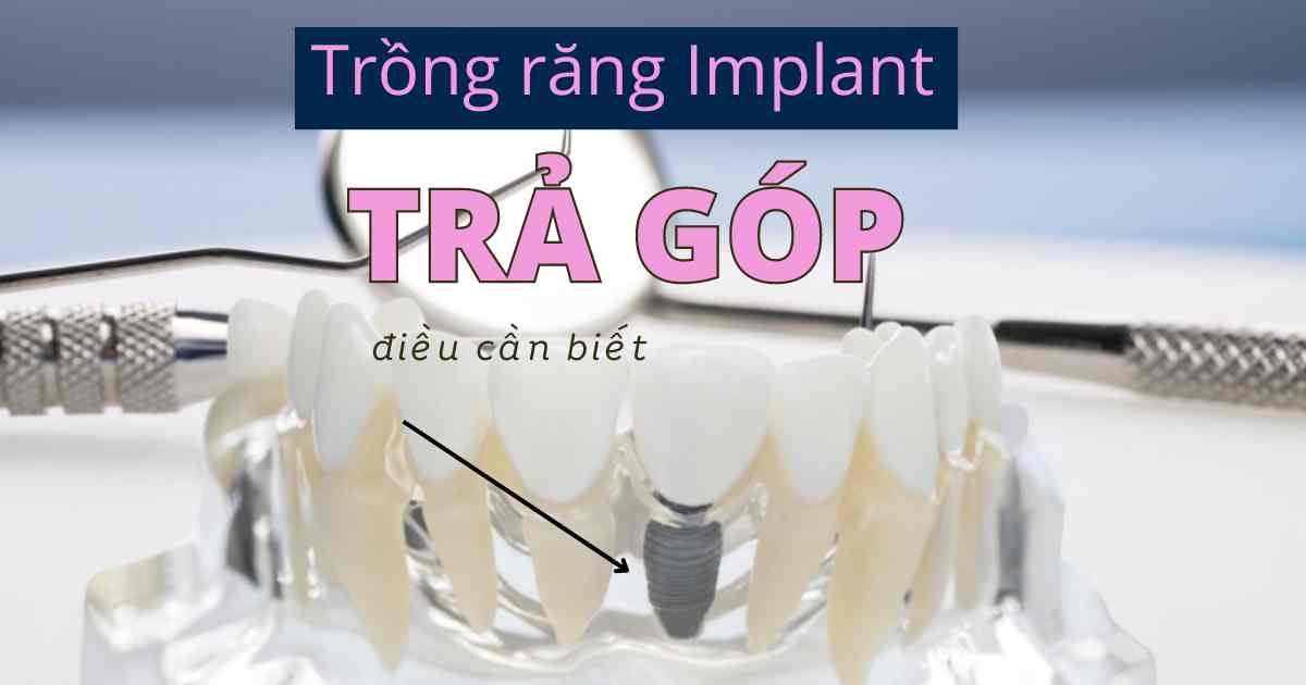 Trồng răng Implant trả góp! 3 Lưu ý để không tăng phí!