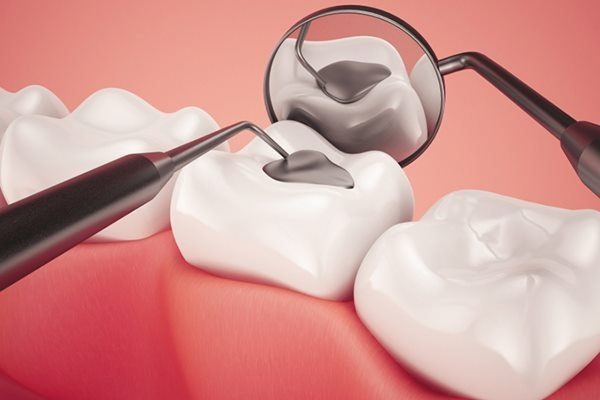 Trám răng là gì? Các bước trám răng và lưu ý sau khi trám