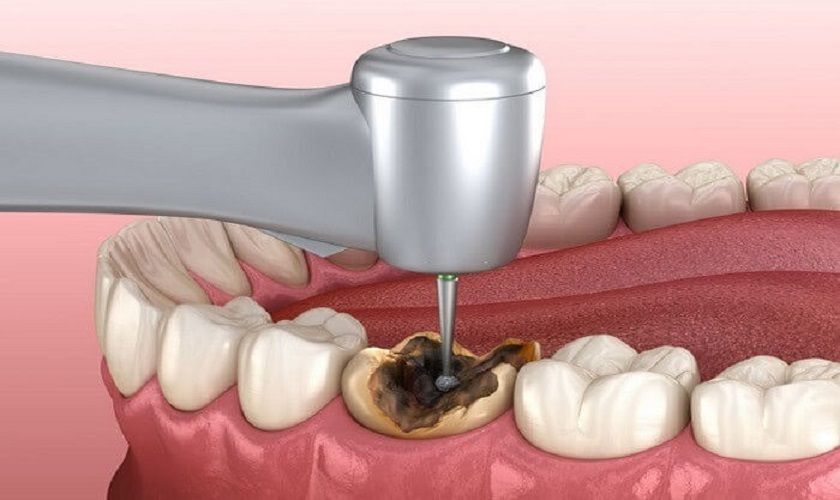 Trám răng có đau không ? Sau khi trám răng phải lưu ý gì