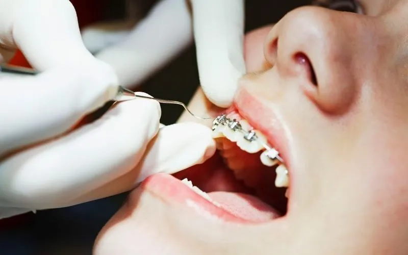 Các giai đoạn niềng răng thưa