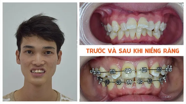 Trước và sau khi niềng răng chen chúc