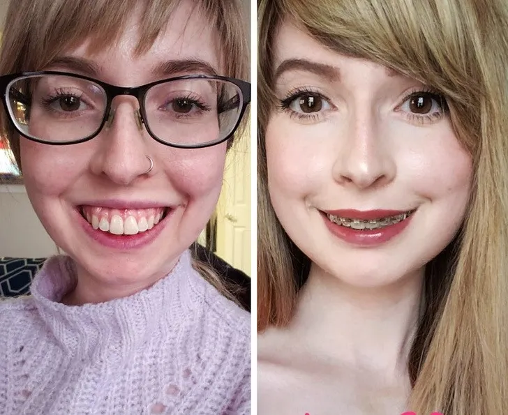 Trước và sau khi niềng răng hô (vẩu)